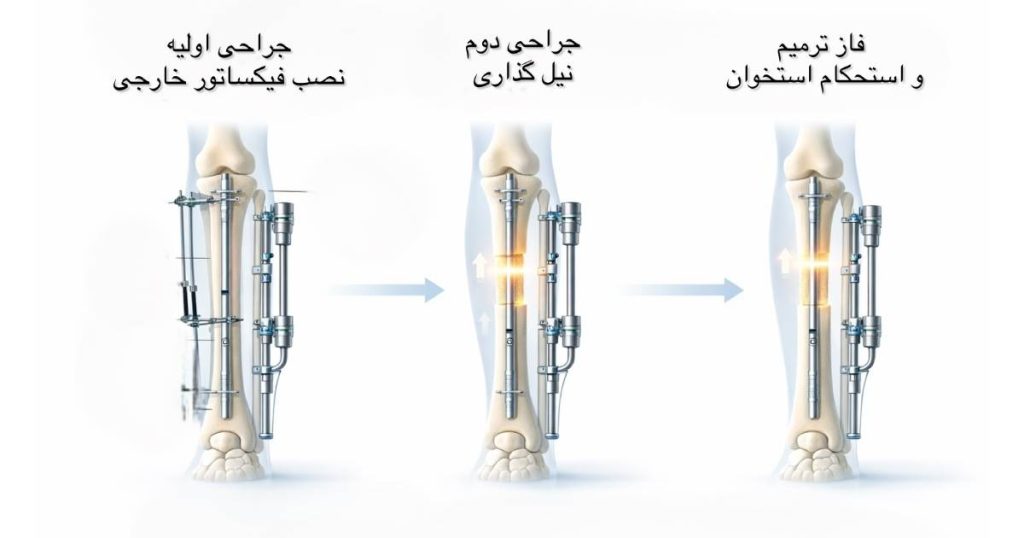 عمل افزایش قد LATN